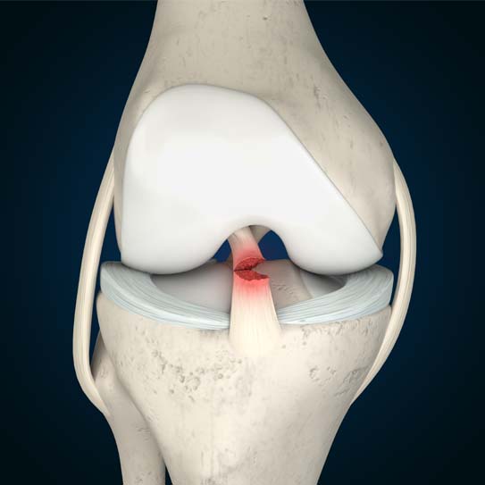 know-more-about-ACL Tear-treatment-in-Lucknow